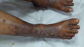 Purpura Fulminans A Thrombotic Disorder [upl. by Barrington]