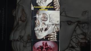 coronoid hyperplasia radiology by dr Mohamed Hasan Osman shorts maxillofacial [upl. by Llerrit766]