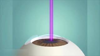 Lasik et PresbyLasik  Opération laser des yeux  Myopie astigmatisme hypermétropie et presbytie [upl. by Nylaras141]