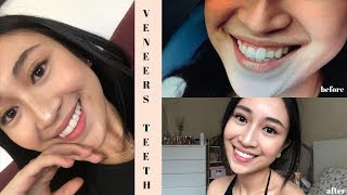 My Glamsmile Veneers Experience [upl. by Jedd]