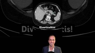 Abdominal CT Tutorials  Diverticulitis [upl. by Akimert]