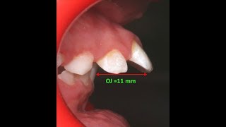 Amazing two phase treatment of Sever Class II Div 1  lama 10Y [upl. by Huai]