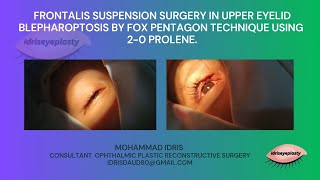 Frontalis suspension surgery in upper eyelid blepharoptosis using 20 prolene [upl. by Nitniuq218]