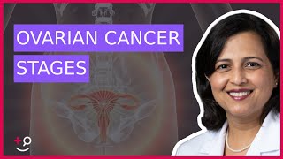 The 4 Stages of Ovarian Cancer by Dr Ruchi Garg [upl. by Esor]