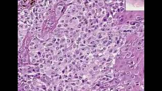 Histopathology Skin Malignant melanom [upl. by Freberg460]