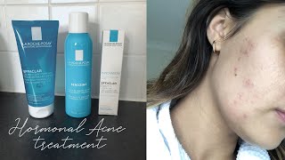 La RochePosay HORMONAL ACNE Treatment ➳ My Experience [upl. by Ellenwahs879]