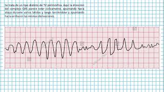 Torsades de pointes  Clases EKG 44 [upl. by Baumbaugh617]