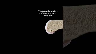 ACL Reconstruction The Importance of Femoral Tunnel Placement aclrepair orthopaedics ortho [upl. by Mintz]