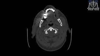 SCANNER DES SINUS Rhinite chronique avec sinusalgies [upl. by Astri803]