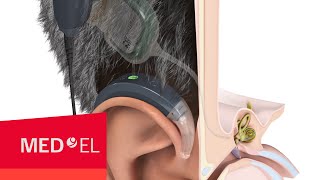 How Do Cochlear Implants Work  MEDEL [upl. by Leisam]