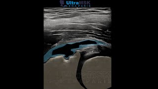 Como evaluar una lesión del labrum anterosuperior de la cadera en ultrasonidoecografía Dra Pari [upl. by Nna357]