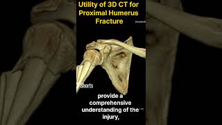 3D CT Scan for Proximal Humerus Communited Fracture [upl. by Ahtinak]