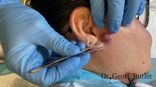 Drainage of an infected cyst in front of the ear [upl. by Emoraj]