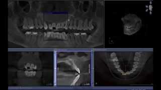 Nasopalatine Duct Cyst  Cone beam computed tomography [upl. by Skier]