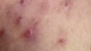 new pimple popping videos blackheads 2023 5 [upl. by Jerol]