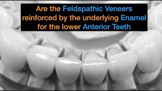 New Video Are these veneers reinforced by enamel [upl. by Atsilac]