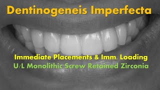 Dentinogenesis Imperfecta Full Arch Immediate Placements amp Loading [upl. by Eenttirb]