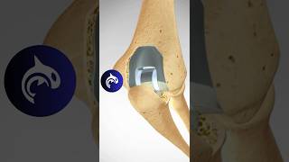 Total Elbow Replacement TER anatomy elbow surgery [upl. by Sida134]