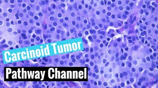 Typical carcinoid tumor of the lung neuroendocrine tumors [upl. by Lune639]