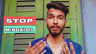 6 months minoxidil beard growth journey results review how to grow beard 🪴 minoxidil beard [upl. by Nythsa548]