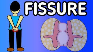 FISSURE  SYMPTOMS  CAUSES  PRECAUTIONS [upl. by Eiznekcam78]