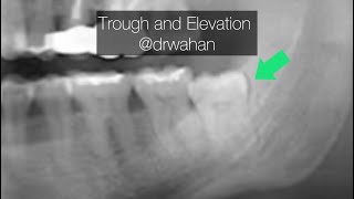 Buccal Trough and elevation for this Wisdom Tooth Extraction drwahan [upl. by Naida]