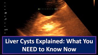 Liver Cysts Explained What You NEED to Know Now [upl. by Drofdeb]