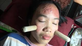 Introduction about inflammatory acne and how to solve it PART 1  official video  742019 [upl. by Chev]