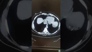 Angiomyolipoma Ctscan [upl. by Adey]