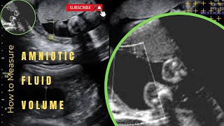 How to Measure Amniotic Fluid Volume by Ultrasound [upl. by Ahsael]