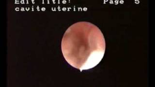 Hysteroscopic aspect of endometrial cancer [upl. by Emyle860]