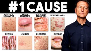 The MOST Common Deficiency in All Skin Diseases Dermatitis [upl. by Molli]