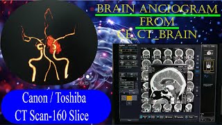 CT Brain Angiogram  From CECT Brain basicradiology [upl. by Yentirb826]