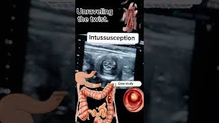 Intussusception A Review of real time ultrasound case Presentation DrSaima khan shorts [upl. by Jariah]