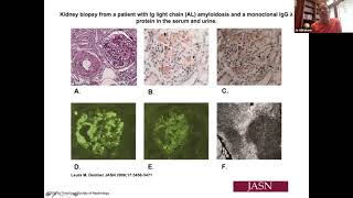 Renal Amyloidosis by Dr Jo Abraham [upl. by Donatelli]