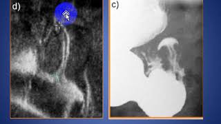 Hypertrophic Pyloric Stenosis ULTRASOUND [upl. by Sellma345]