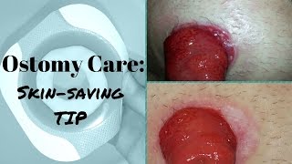 Ostomy care Healing the Skin around the Stoma [upl. by Eillam]