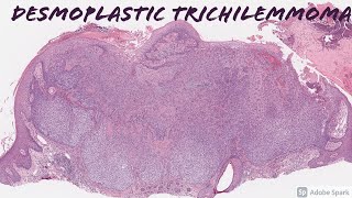 Desmoplastic Trichilemmoma 101 [upl. by Marcile]