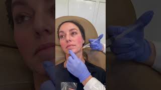 Behind the scenes of an appointment for Sculptra and Restylane Filler filler sculptra restylane [upl. by Ariday346]