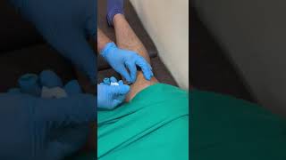 Intraarticular injection of hyalgan in knee osteoarthritis [upl. by Sakram]