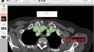 Aortic Segmentation  How i do it with Osirix [upl. by Zug]