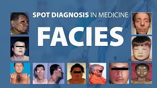 Abnormal Facies  Spot Diagnoses in Medicine [upl. by Wescott]