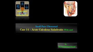 Ultrasound Case 14  Acute Calculous Sialadenitis Web case [upl. by Sandro]