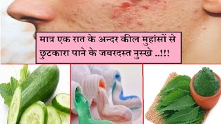 मात्र एक रात मैं कील मुहांसों Pimples से छुटकारा पाने के जबरदस्त नुस्खे [upl. by Aiym]