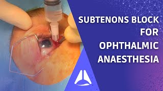 Subtenons block regional anaesthesia for ophthalmic surgery Live patient UPDATE [upl. by Artinak]