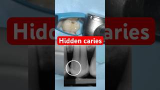 Hidden Cavities What Your Dentist Sees That You Don’t 🦷🔍 fyp viralvideo dentist satisfying [upl. by Anivol]