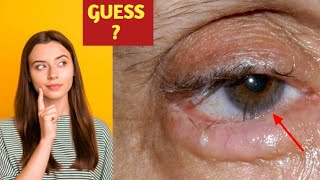 Eyelid condition explained indetail eyecareoptom5506 eyelid surgery treatment [upl. by Eeramit]