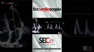 Curso de Ecocardioscopia Ecocardiografía básica [upl. by Farro629]