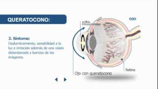 Síntomas y tratamiento del queratocono  Clínica Baviera [upl. by Ryon]