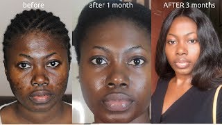 How to Brighten Skin Reduce Acne Scars Discoloration Uneven skin tone  Home Remedies [upl. by Htur]